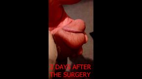 8495 pounds for Penis Enlargement Surgery Penile Girth and Length Surgery
