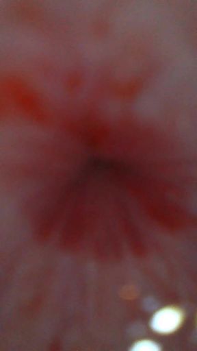 Endoscope from urethral opening to bladder