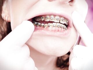 ASMR: upgraded braces with chain-link rubber bands and nitrile gloves (Arya Grander)