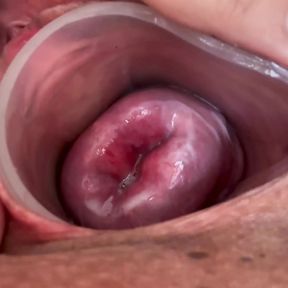 Small cervix without dilating