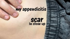 my appendicitis scar