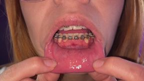Glasses and braces
