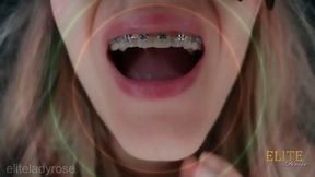 Mesmerizing braces