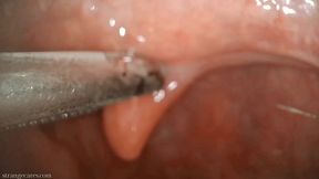 uvula manipulation with swab and forceps