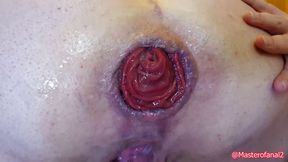 Extreme anal with prolapsing