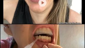 BURCHING WITH A DIRTY MOUTH AND Teeth Whitening