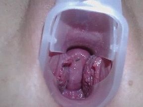 Teen exploring cervix & deep vagina with speculum