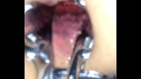 Shemale used speculum on me