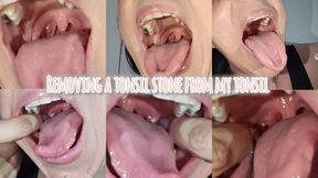 Removing a tonsil stone from my tonsil