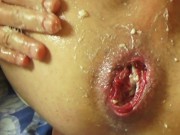 Penis pump prolapse gape ( Массаж простаты)