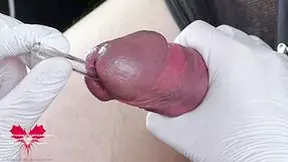 Perfect Extraction Of Sperm Directly From The Urethra. Close-up Of The Glass Straw Sounding