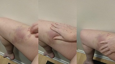 I love playing with my bruises and seeing the way the colours change when you poke them
