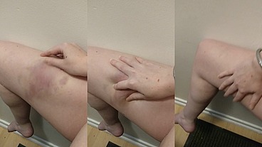 I love playing with my bruises and seeing the way the colours change when you poke them