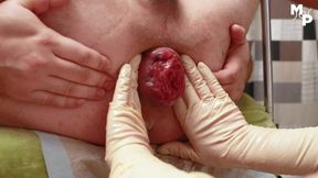 Extreme femdom fisting and prolapse play