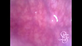 Anal Endoscope all the way in my Transverse Colon!