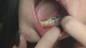 Tour of my mouth & dental work