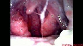 choking phlegm ENDOSCOPY wmv