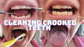 Cleaning Crooked Teeth