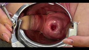 Two Toothbrushes in Cervix