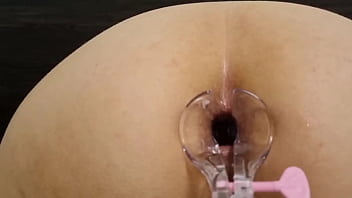 Speculum view inside ass