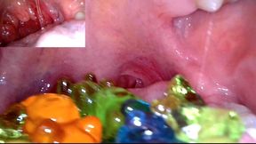 Vore- gummy bears endoscopy