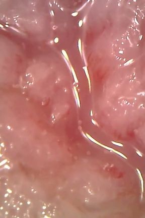 Medical Endoscope Oral Exam: Gummy Chewing, Extreme Teeth &amp; Tongue Macro