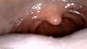 yawning uvula endoscopy (720 wmv)