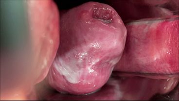 Masked Whore Extreme Cervix View and Double Vaginal Fisting