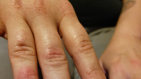 Eczema On My Hands