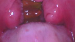 Gummy Bear Swallow (ENDOSCOPE FOOTAGE)