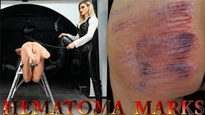 HEMATOMA MARKS HD