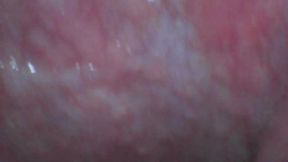 Bailey Mouth Endoscope 2