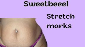 Stretch marks