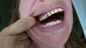 Dental fillings on my teeth 2 a