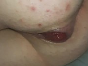 Huge extreme Anal gaping 3" black ball insertion and huge anal prolapse.hot anal compilation #1 2024