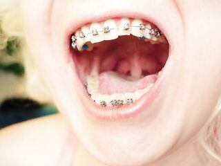 My 2nd day in braces: cleaning by dental floss