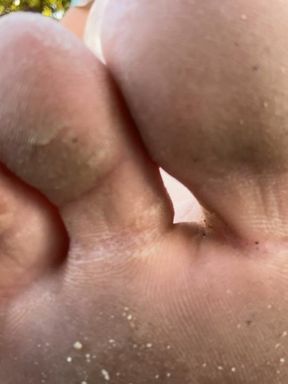 pov: blister popped and dried out. dirty feet in your face.