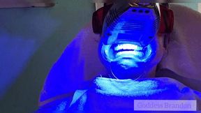 Dental Teeth Whitening