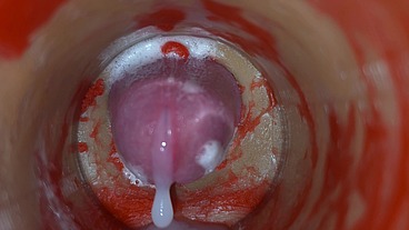 Insemination - Internal Camera Captures Deep Male Ejaculation