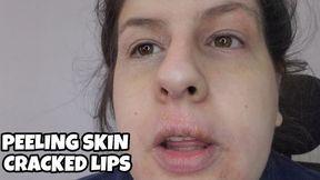 Infected Cold Sore Lips & Peeling Skin | Red Irritated Face Fetish, Flaky Skin, Cracked Lips, Red Eyes Close-Up