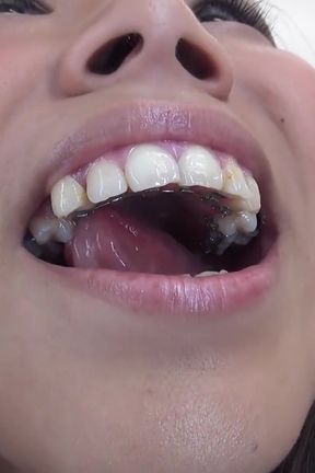 Orthodontic Teeth Fetish: Izumi Asato's Dental Fantasy