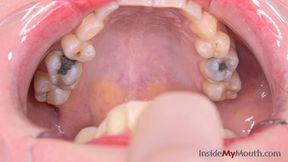 Inside My Mouth - Barbie - Mouth retractor inserted ( HD quality )
