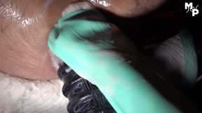 Extremely stretched anal canal