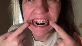 Licking Your Braces with Your Tongue