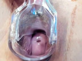 Show with cervix opened with speculum
