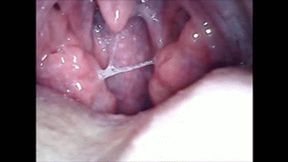 Sick tonsils endoscopy wmv