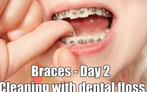 Close up mouth tour, braces and dental floss