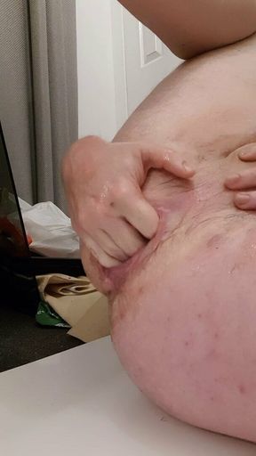 Anal fisting &amp; prolapse