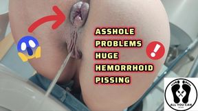 PISSING WITH A BIG HEMORRHOID IN MY ASSHOLE ANAL PROBLEMS