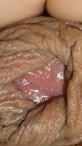 Boy with Large Anal Phimosis Excited!